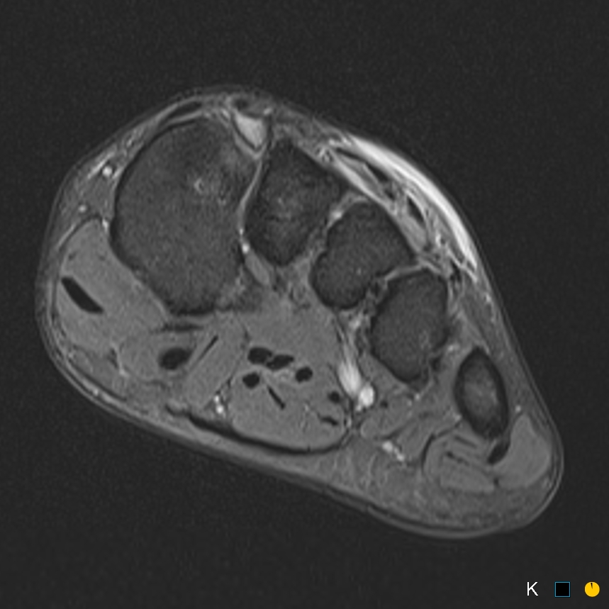 Figure 3 for case Symptomatic os intermetatarseum